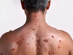 Hubungan Intim Jadi Salah Satu Cara Penyebaran MPOX