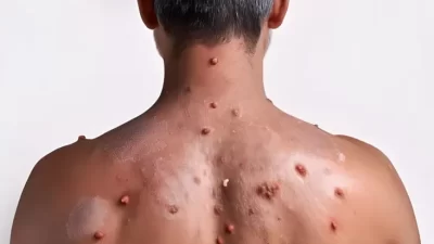 Menelusuri Jejak Mpox yang Menyebar ke Manusia Lewat Hubungan Intim