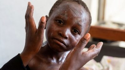 Kini Anak-anak Jadi Sasaran Mpox, Perhatikan Tanda-tanda dan Cara Penyebarannya