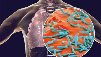 Pemerintah dan Swasta Bersinergi, Komitmen Anti-TB di Indonesia Semakin Kokoh