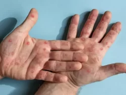 Cacar Monyet, Cacar Air, dan Campak: Ketiganya Tak Sama Saja!