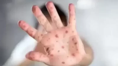 Kemenkes Menegaskan Tidak Ada Kaitan Antara Vaksin COVID-19 dan Mitos Penyakit Mpox