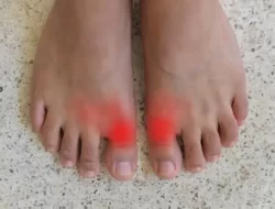 Ketahui Kondisi Stres Bisa Menyebabkan Penyakit Asam Urat Dampaknya Serius