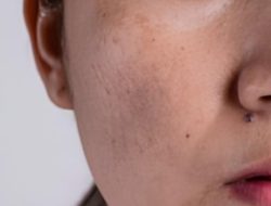 Penyebab, Pengobatan, dan Tips Efektif Mengatasi Melasma Wajah